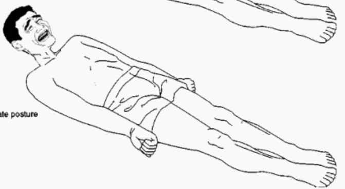 <ul><li><p>stiffly extended upper extremities</p></li><li><p>palms pronated</p></li><li><p>flexed wrists</p></li><li><p>stiffly extended lower extremities</p></li><li><p>**indicates lesion in brainstem*</p></li></ul><p></p>