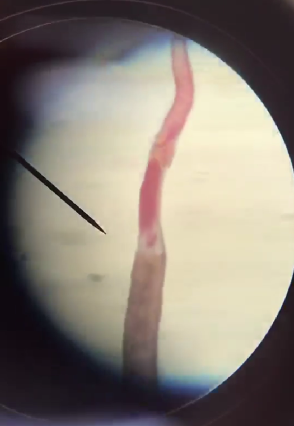 <p>Trematoda; blood fluke</p>