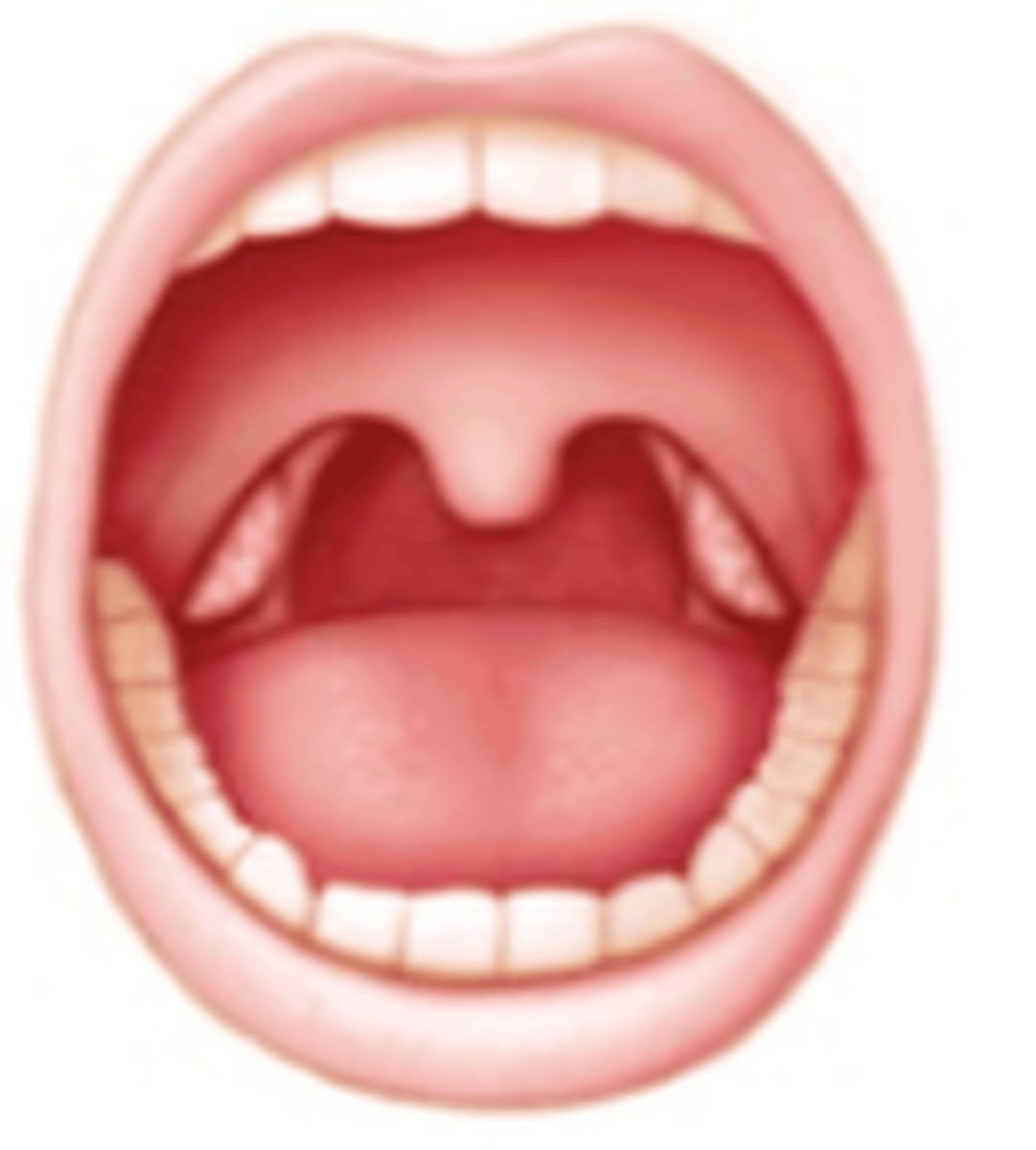 <p>Brodsky:</p><p>Tonsils hidden within tonsil pillars</p>