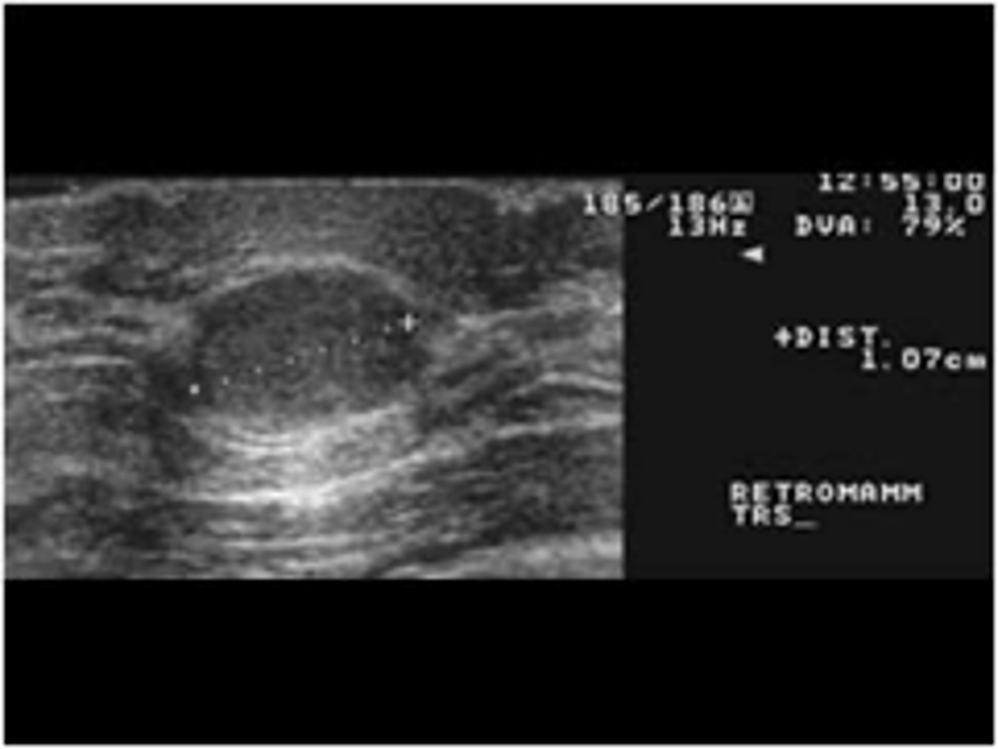 <p>15-25 yo</p><p>Single or multiple</p><p>Round, disc or lobular</p><p>Usually firm</p><p>Well-demarcated</p><p>Mobile</p><p>Nontender</p>
