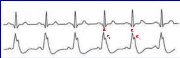 <p>What rhythm is present on the ECG?</p>