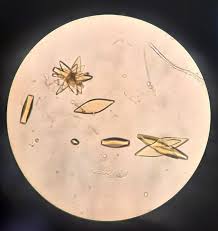 <p>acid urine</p>