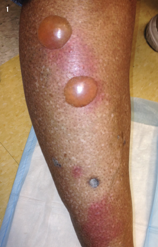<p>Bullae</p>