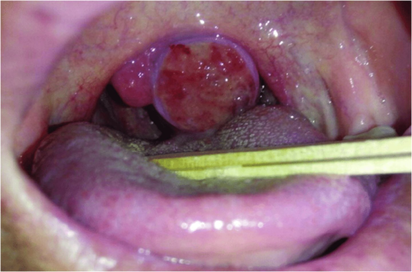 <p>The tonsillar artery, a branch of the facial artery, supplies the tonsillar fossa.</p><p>TONSILLAR ARTERY: BRANCH OF FACIAL ARTERY</p>