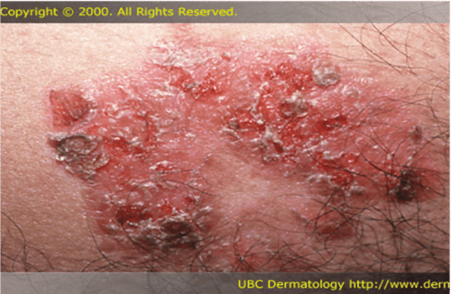 <p>________________: </p><p>•Dried serum or exudates on the skin surface</p><p>•Blood appears brown</p><p>•Serum is honey colored</p><p>•Pus is a combo of yellow &amp; green</p><p>•Present after blisters rupture</p>