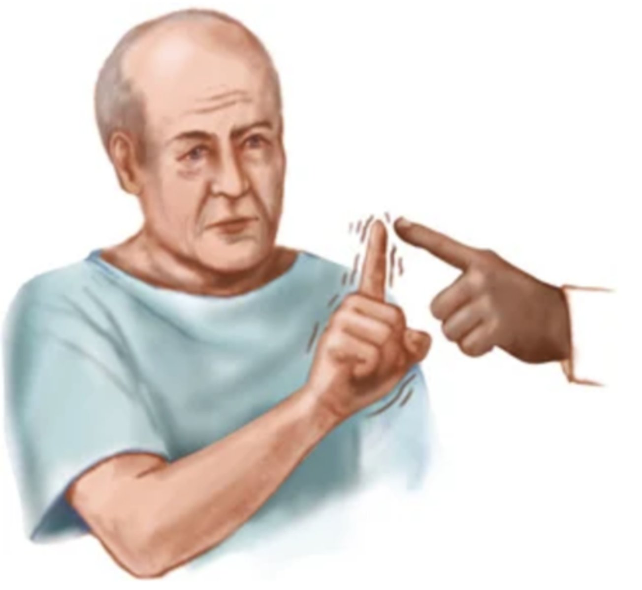 <p>Tremor that appears with voluntary movements; medications can calm it</p>
