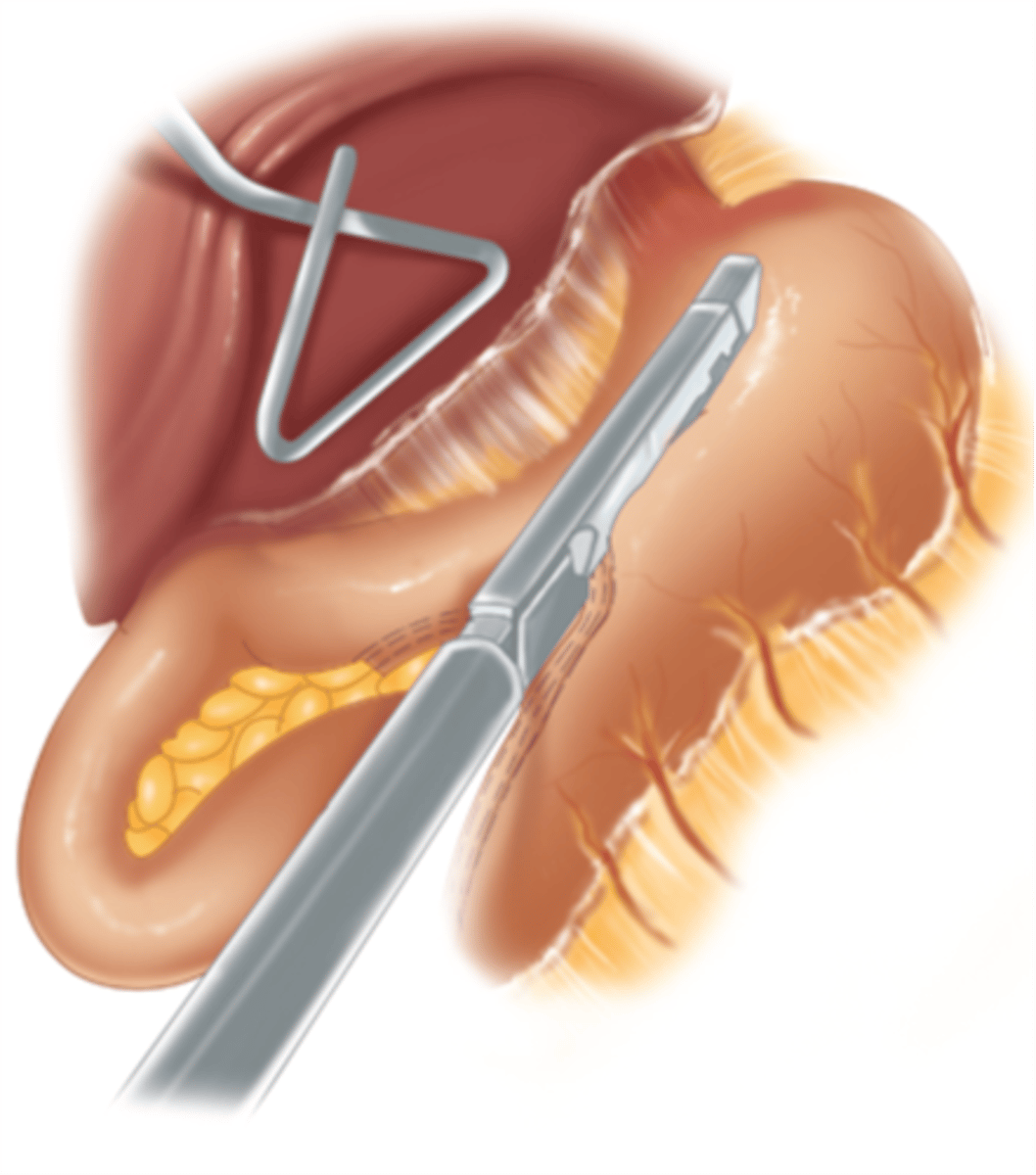 <p>Portion of stomach is removed, leaving a banana-shaped stomach pouch</p>