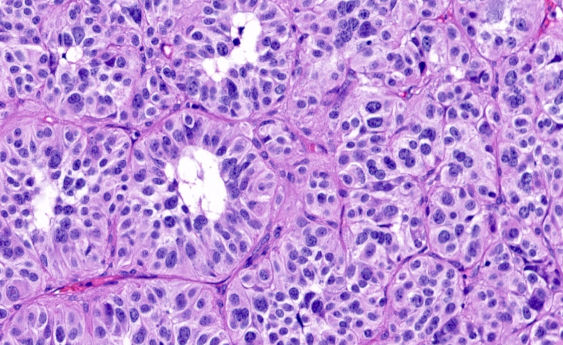 <p>Dog, Lung. Most likely diagnosis and cell of origin? </p><p>In horses where does this type of tumor arise? </p>