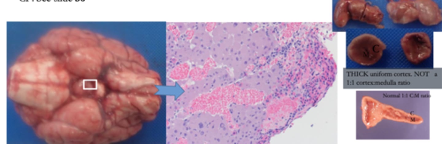 <p>Define Adenoma:</p><p>5% of PitNETs</p><p>-Path: Secrete Excess ACTH --&gt; Bilat Adrenal Hyperplasia --&gt; HYPER-SECRETION of Cortisol from Adrenal Cortex</p><p>-Sx/PE:</p><p>&gt; Cushing Disease (From HYPER-SECRETION of CORTISOL)</p><p>&gt; Hyperpigmentation (More POMC --&gt; ACTH, More MSH --&gt;&nbsp;More Melanin)</p><p>-Dx: (Histo)</p><p>&gt; Sheets of Basophilic Pituitary Cells w/ scant reticulin</p>