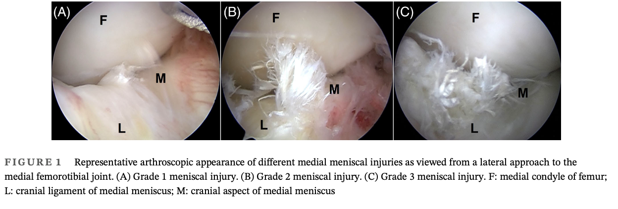 <p>Objective: To report the findings and long-term outcome of 76 sport horses with meniscal injury</p><p>Results:</p><ul><li><p>The medial meniscus was involved in 82.8% of cases with grade 1 injuries diagnosed in 76.3% of menisci</p></li><li><p>Overall, 85.5% of horses returned to athletic performance with 40% returning to their previous level</p></li><li><p>The grade of meniscal injury was associated with long-term outcome</p><ul><li><p>Horses with grade 1 meniscal injuries had a better long term outcome than horses with grade 3 meniscal injuries</p></li><li><p>There were no difference in long-term outcome between horses with grade 1 and grade 2 injuries or between horses with grade 2 and grade 3 injuries</p></li></ul></li><li><p>The presence of preoperative radiographic abnormalities or additional joint pathology was not associated with long-term outcomes</p></li><li><p>59 stifles were treated with an orthobiologic: autologous conditioned serum, platelet-rich plasma, or marrow-derived mesenchymal stem cells</p></li><li><p>There was no association between the use of any orthobiolgoic and long-term outcome</p></li><li><p>The presence of articular cartilage fissure in the femoral condyle was associated with a negative long term outcome</p></li></ul><p>Conclusion: This is the first report on long-term outcome of sport horses with meniscal injuries following arthroscopic surgery. Overall, the longer-term prongosis was fair with 40% of horses returning to their previous level of use. Severity of the meniscal injury was a prognostic indicator for return to work. The presence of radiographic abnormalities or additional joint pathology or the use of orthobiologisc was not associated with long-term outcome</p>