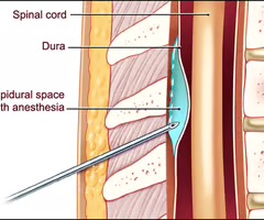 <p>epidural space of the spine</p>