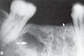 <p>RL multilocular lesion commonly seen in middle aged women with <strong>osteoporosis</strong></p>