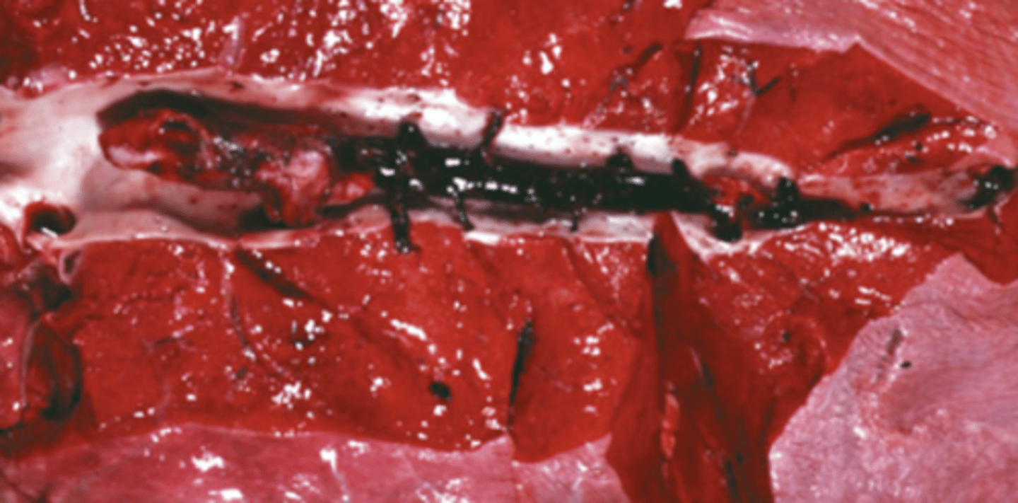 <p>What type of thrombus is being shown?</p><p>arterial or venous</p>