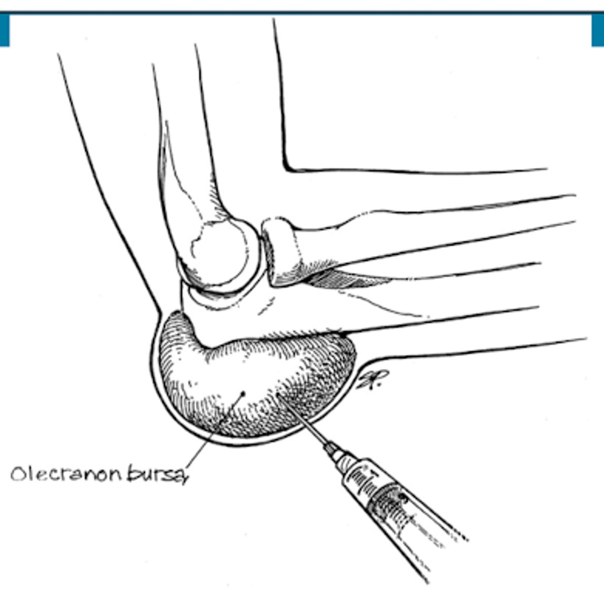 <p>TRUE - can help r/o cause (sepsis, RA, gout, etc)</p><p>- if no infection → can re-aspirate + inject steroids</p>