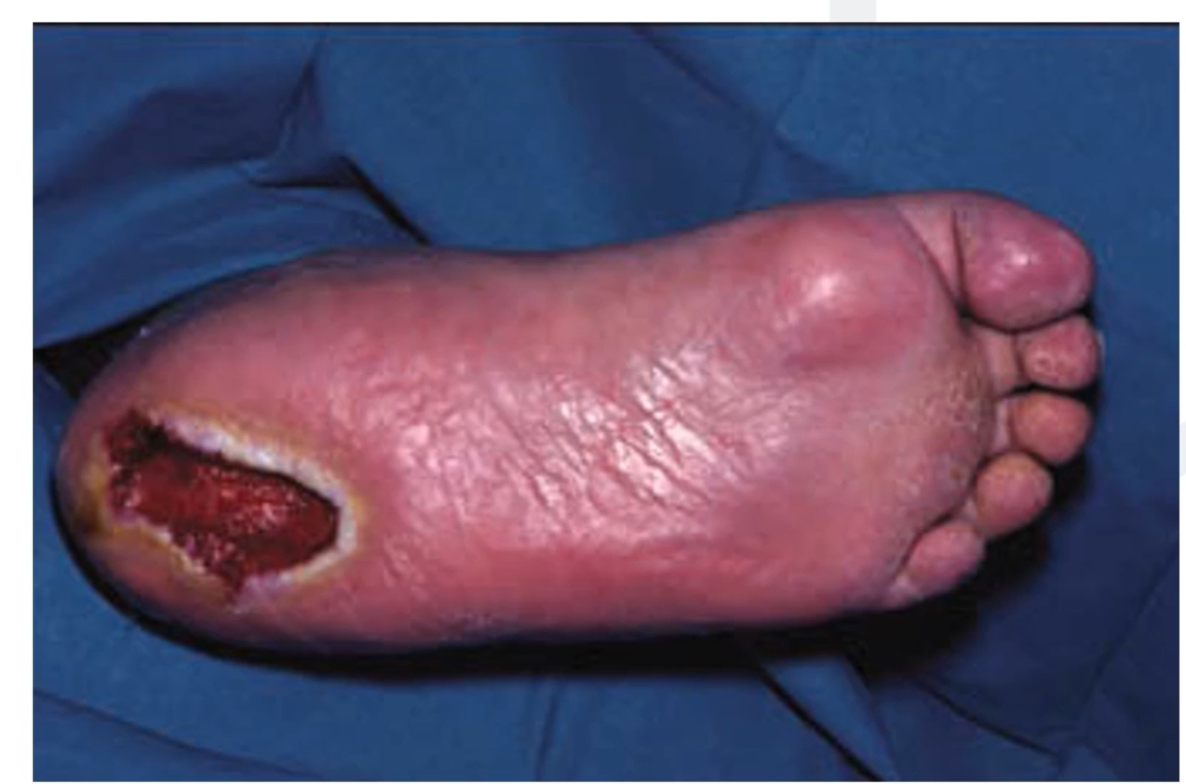 <p>Red tissue here is good as it shows it is healthy, macerated white tissue around the outside is an issue though </p>