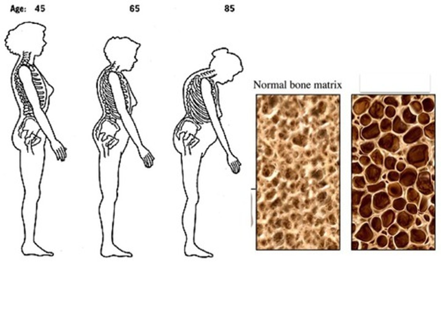 <p>A bone disease that causes bones to weaken and become brittle</p>