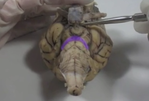 <p>Cerebral Peduncles </p>