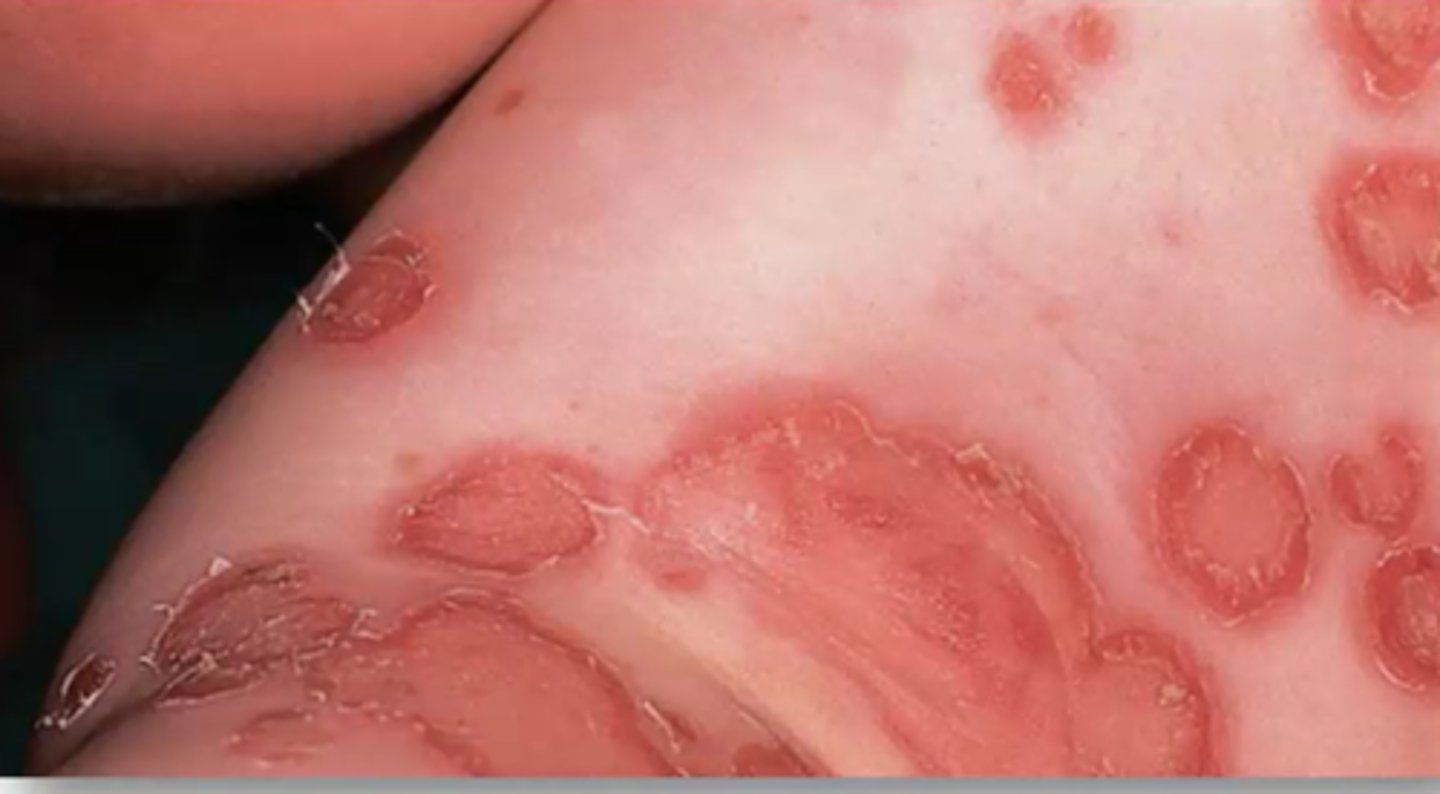 <p>Which kind of impetigo is characterized by vesicles containing clear yellow fluid that discharge to form a thin, light brown crust?</p>