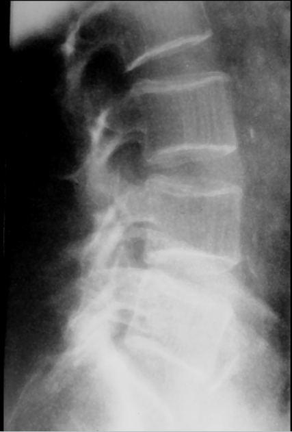 <p>what is seen here for this case of osteoporosis?</p>