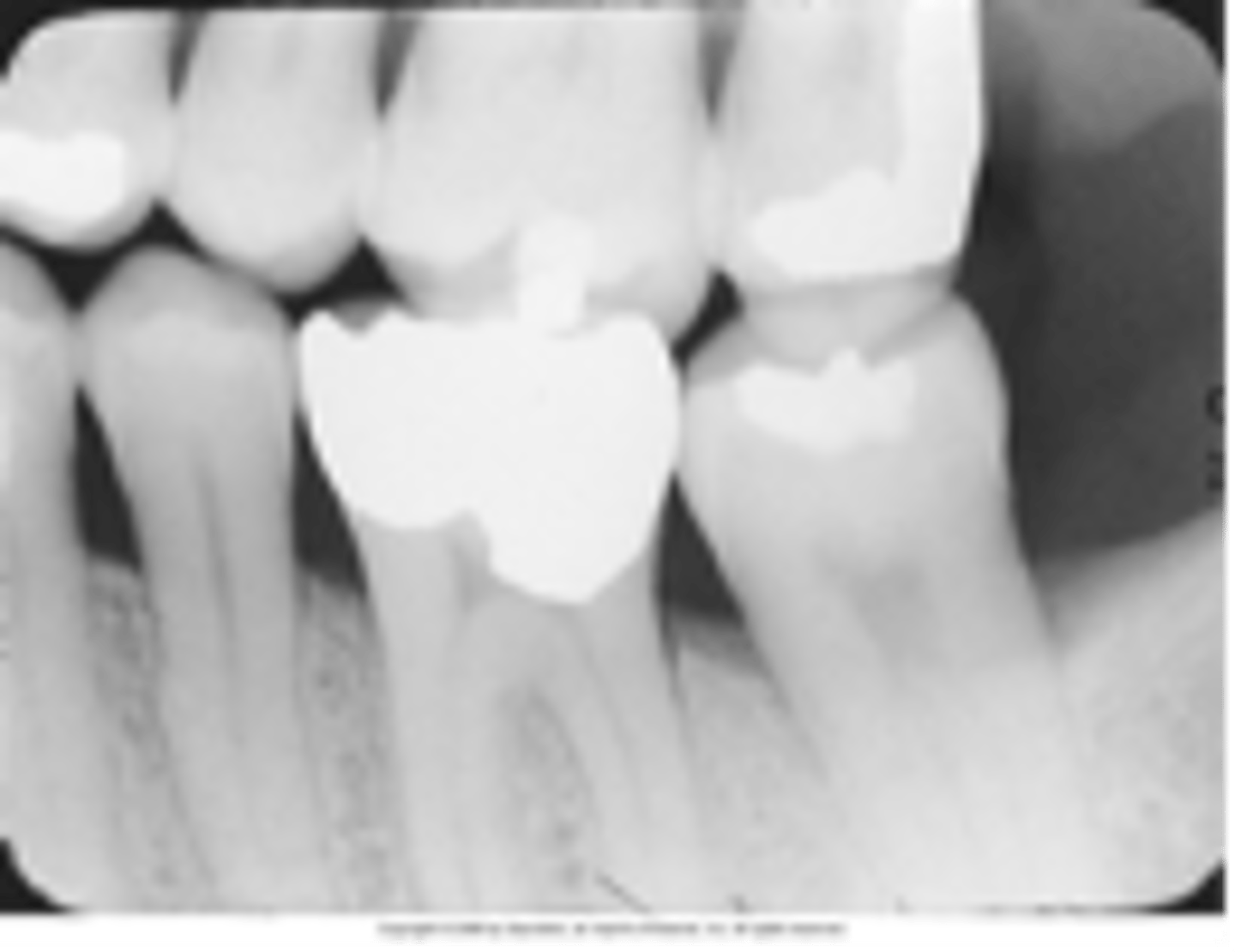 <p>incorrect vertical angulation</p><p>vertical angle was negative</p><p>use +10 degree angle when using bite tab</p>