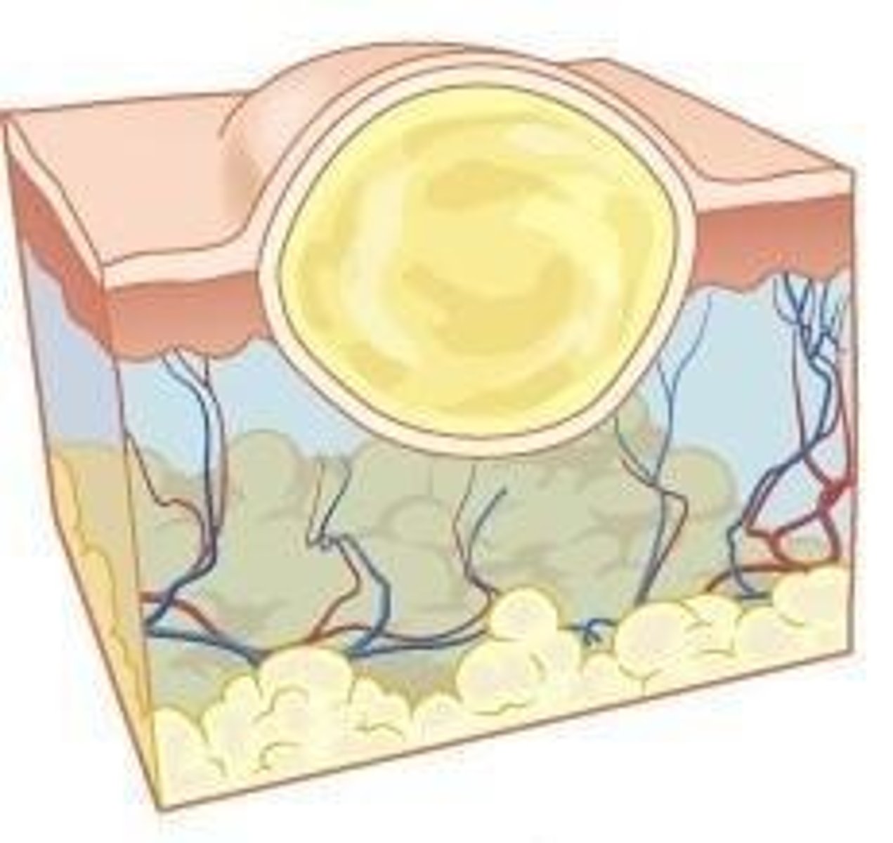 <p>Topical or oral antibiotics.</p>