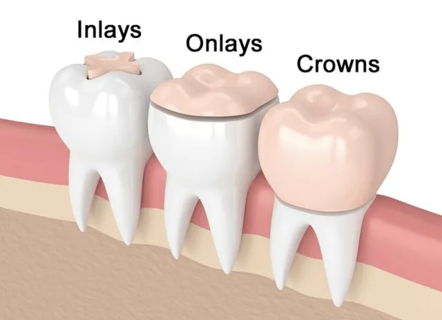 <p>Inlays, onlays, and full crowns </p>