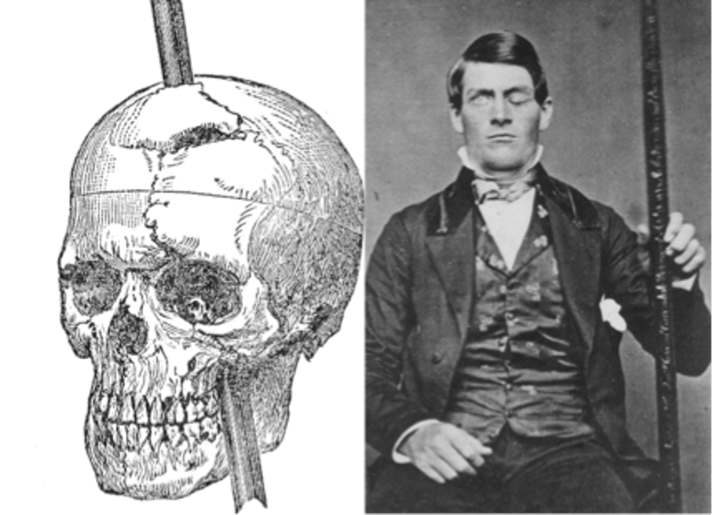 <p>Railroad worker who in 1848 had an accident where a rod shot through his brain and damaged his pre-frontal cortex.</p><p>He became quite different. His friends said "Gage was no longer Gage." His damaged pre-frontal cortex made him no longer able to control emotions or plan for the future. He became rude and crude.</p><p>He could not regulate his emotions coming from his amygdala</p>
