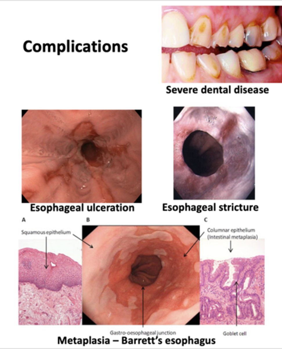 <p>Complications of this GI disease include:</p><p>- Severe dental disease</p><p>- Esophageal ulceration</p><p>- Esophageal stricture</p><p>- Barrett's esophagus</p>
