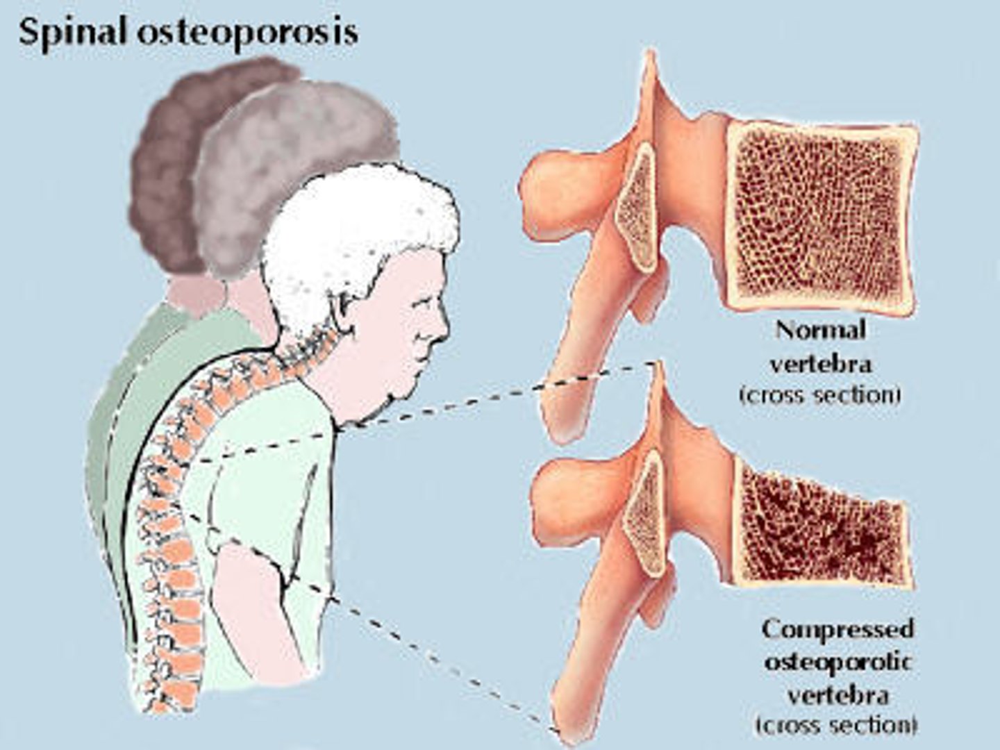 <p>A condition in which the body's bones become weak and break easily.</p><p>- Silent disease</p><p>- Mainly in white, older, and thin females</p>