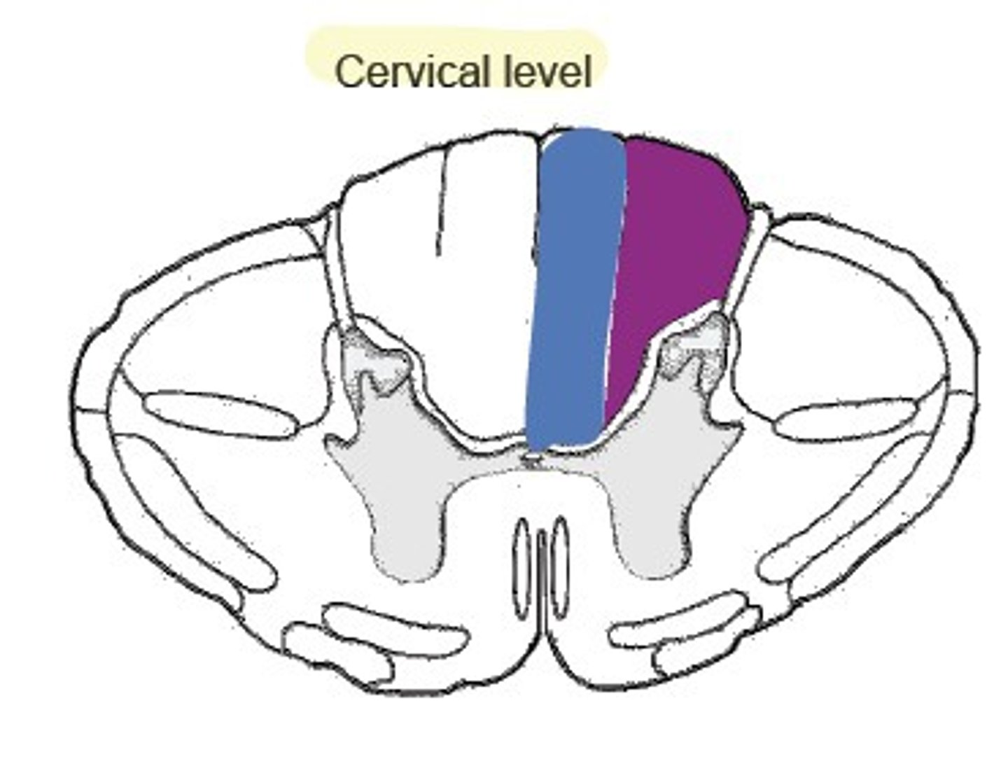 <p>- light touch and proprioception</p><p>- decussate in brainstem</p>