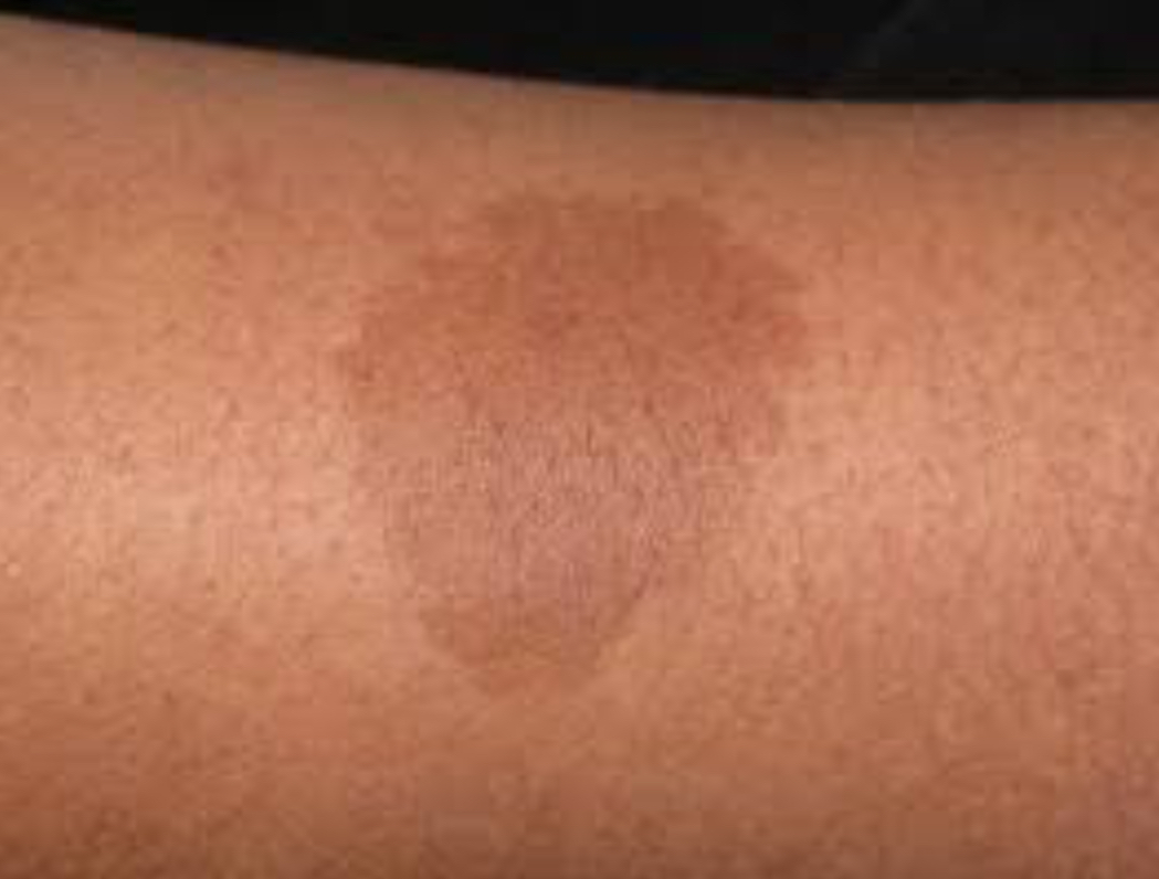 <p>Macule</p>