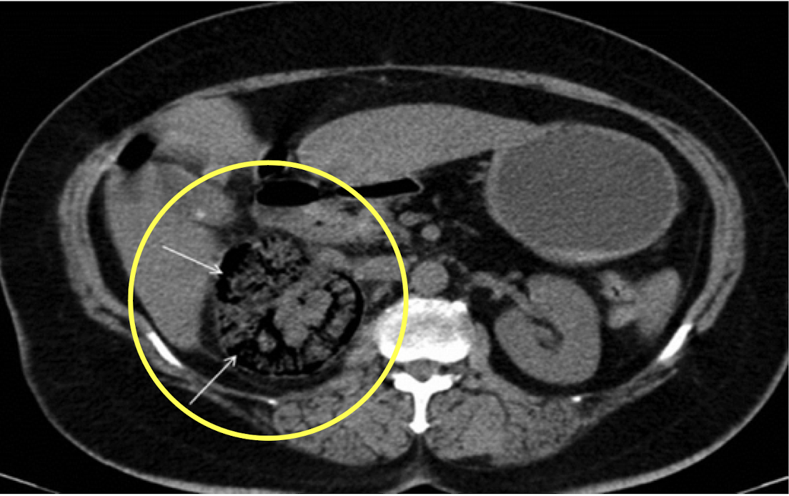 <p><em>CT Abdomen/Pelvis IV contrast</em></p>
