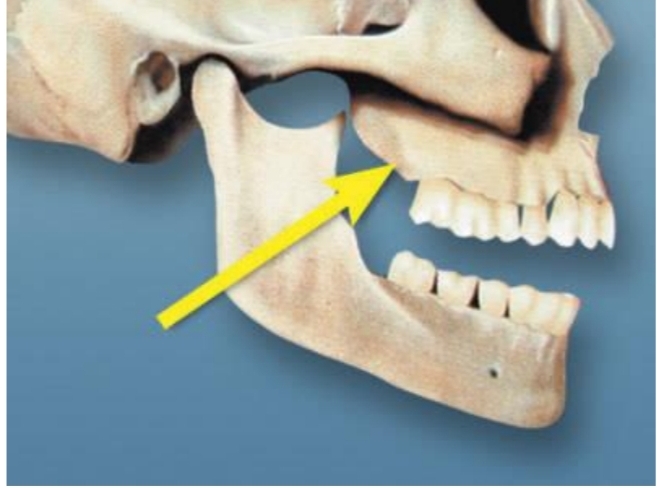 <ul><li><p>Heavy bone located distal to last posterior tooth</p></li><li><p>Very important when constructing a denture</p></li></ul><p></p>