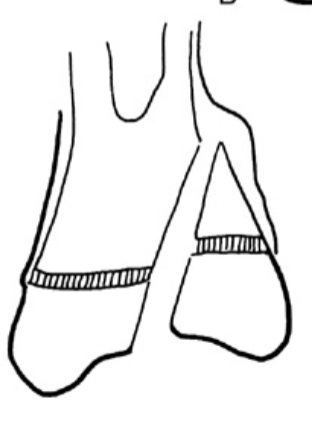 <p><strong>What type of Salter Harris fracture is the following:</strong></p><p>Fx through distal Metaphysis, Physis &amp; Epiphysis</p>