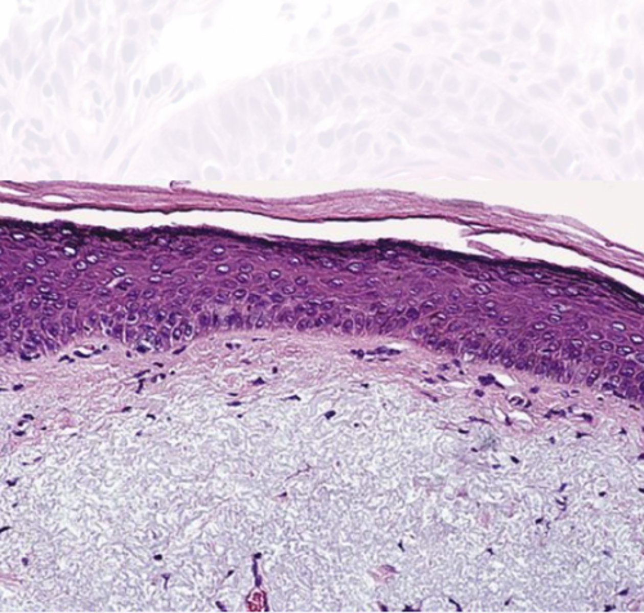 <p>These histology characteristics are indicative of what premalignant epithelial pathology?</p><p>*Solar Elastosis*</p><p>Inflammation</p><p>Dysplasia</p><p>Hyperkeratosis</p>