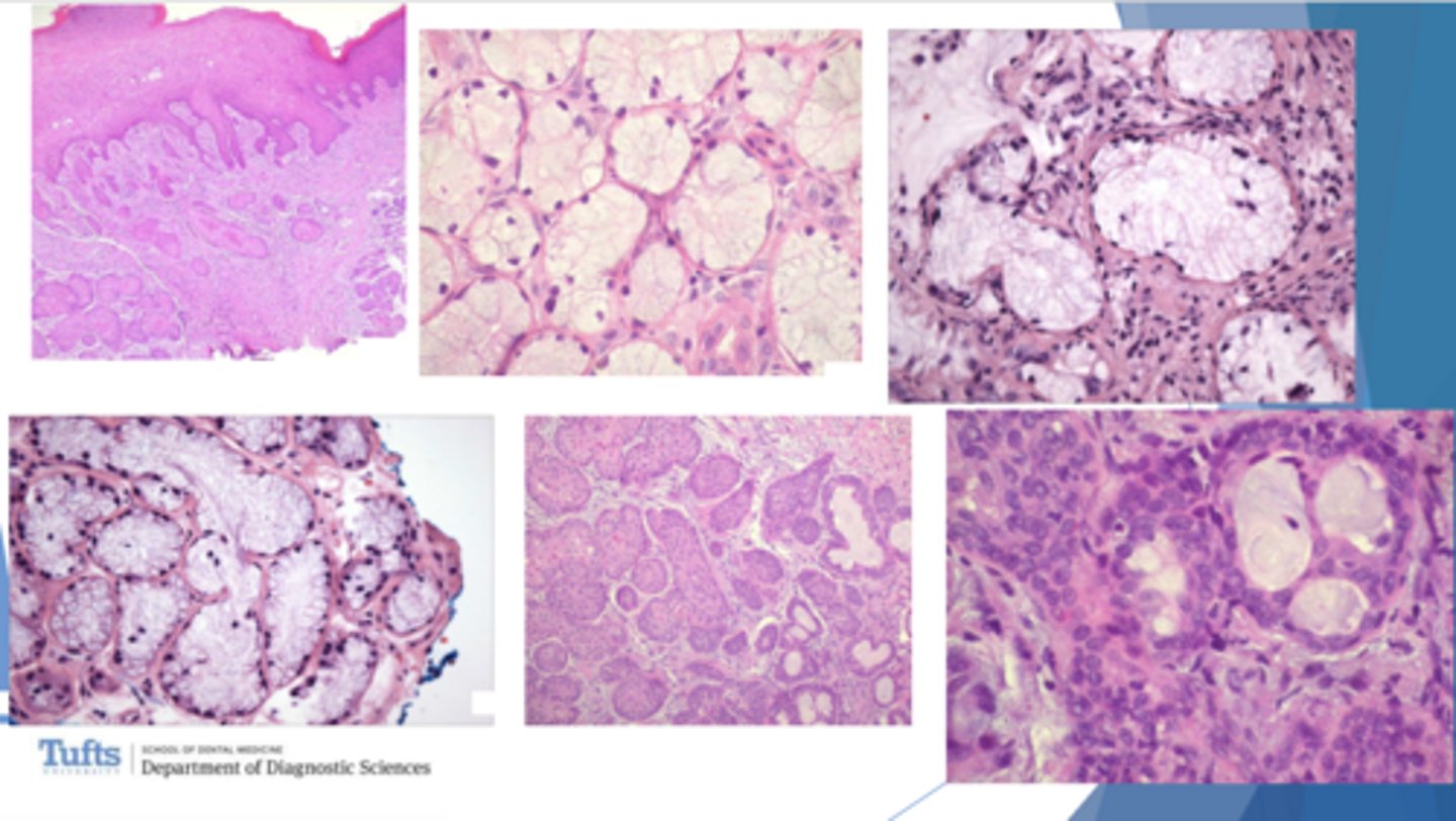 <p>ID the pathology based on the histology findings:</p><p>- Acinar<strong> necrosis</strong> with preservation of lobular architecture</p><p>- <strong>Squamous metaplasia</strong></p><p>- Pseudoepitheliomatous <strong>hyperplasia</strong></p>