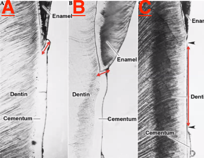<p>which of these conditions is the most common form of acellular afribrillar cementum</p>
