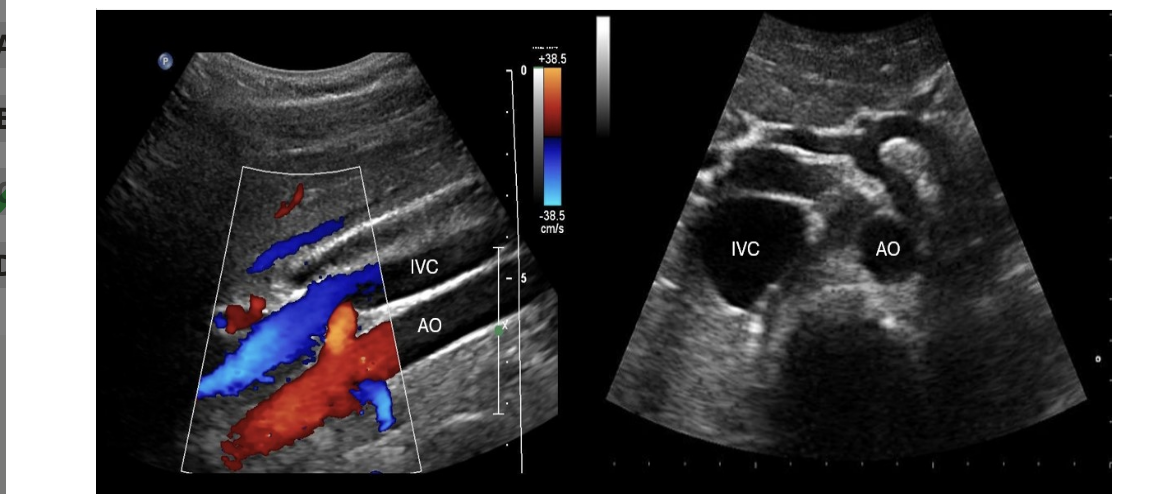 <p>which imaging plane shows the IVC + AO on the same image in a normal pt</p><p>.</p><p>a) coronal</p><p>b) transverse</p><p>c) midsagittal </p><p>d) coronal + transverse </p>