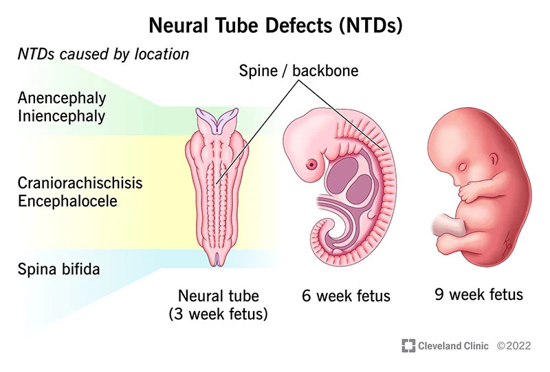 <ul><li><p>anencephaly</p></li><li><p>encephalocoele</p></li><li><p>spina bifida</p></li></ul>