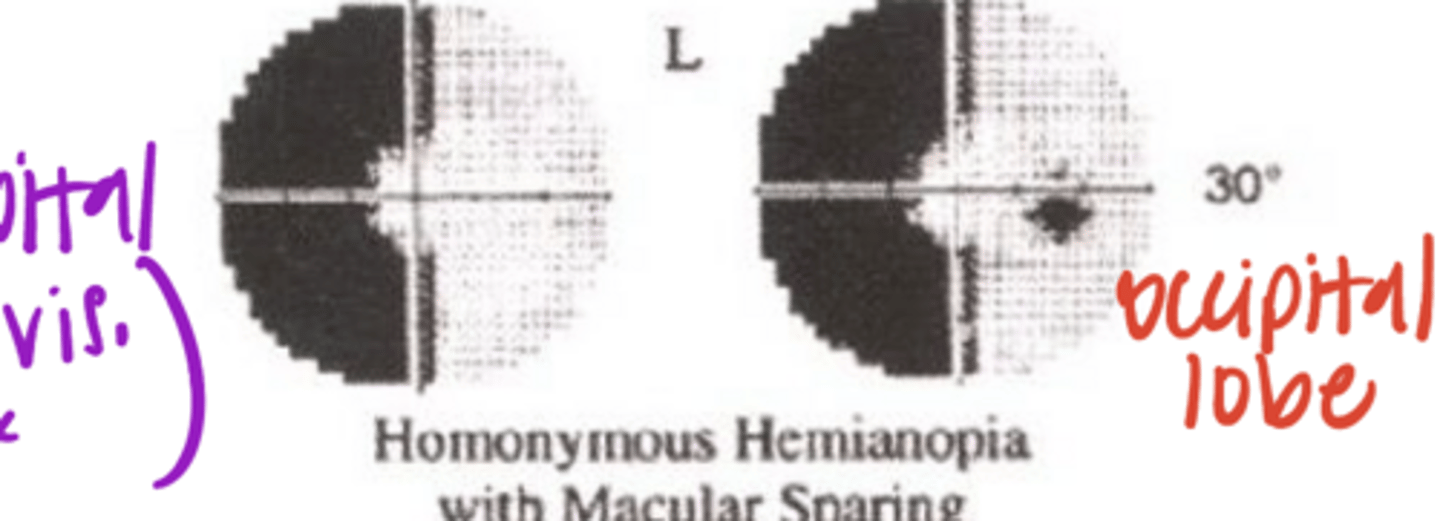 <p>Why is macular sparing present with a defect to the occipital lobe?</p>