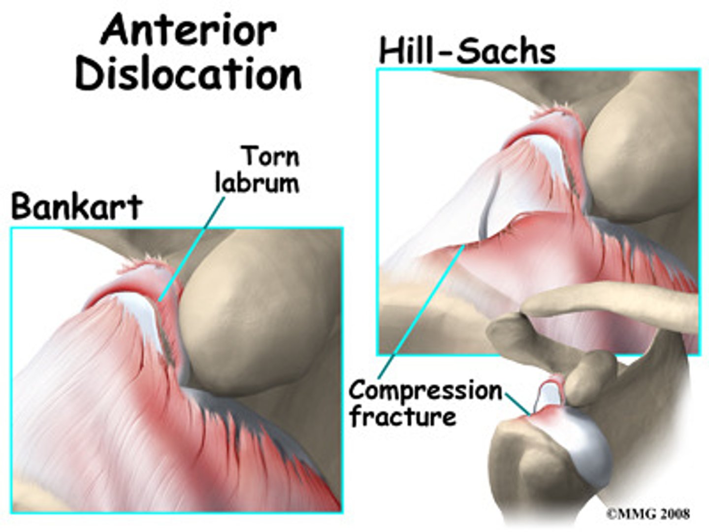 <p>Bankart lesions and hills sach deformity</p>