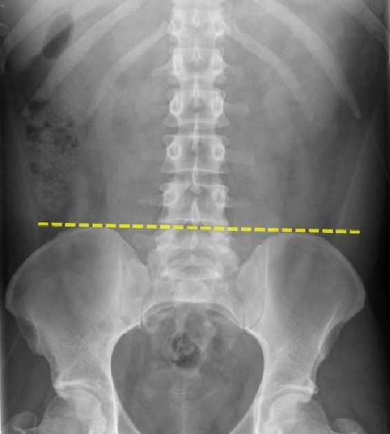 <p>The spinous process of L4 vertebrae</p><ul><li><p>aligns with the intercristal plane (a line drawn between iliac crests)</p></li></ul><p></p><p>identifies the L4-5 intervertebral space, which is ideal site for performing LP</p><p></p>
