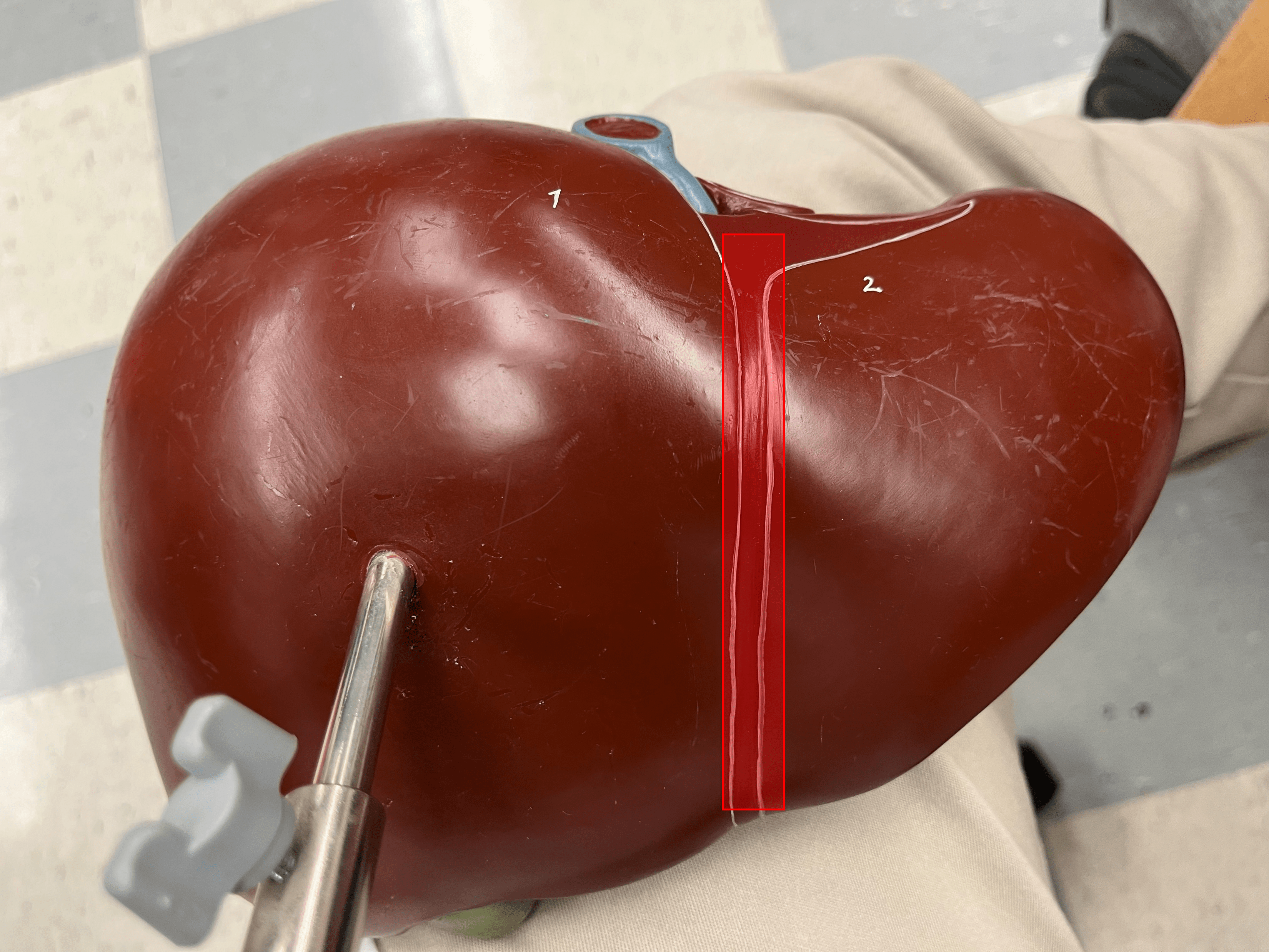 • Suspends the liver from the diaphragm and the anterior abdominal wall.

• Separates the right and left lobes of the liver.