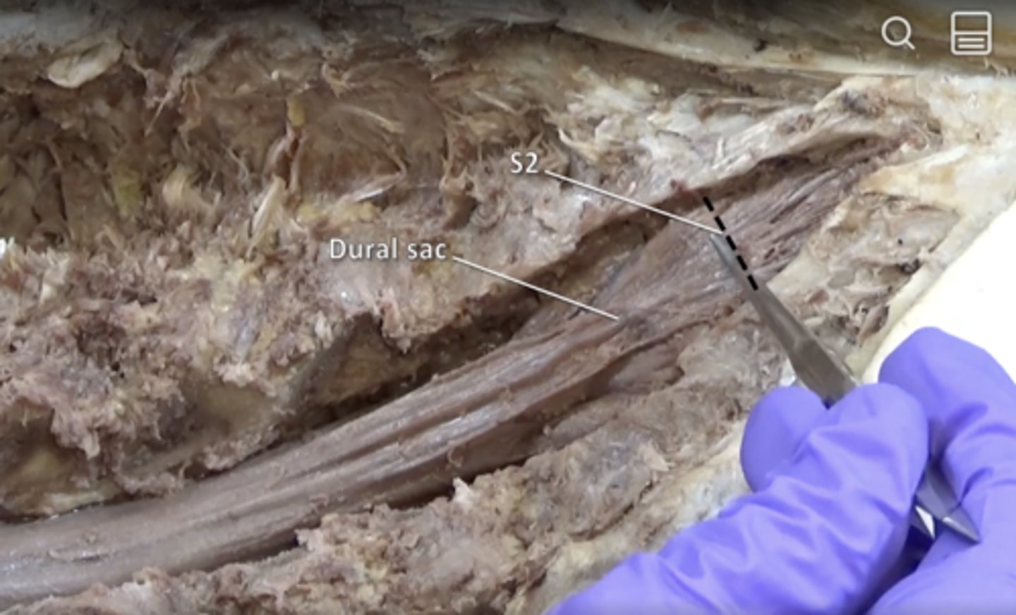 <p>tubular sheath containing spinal cord formed by dura mater. Ends at S2</p>