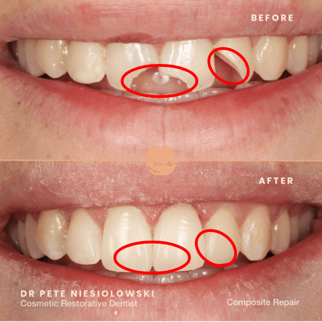 <p>Materials made by combining two or more different substances (like resin + filler) to improve strength and appearance.</p>