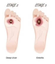 <ul><li><p>Grade 2</p><ul><li><p>deeper extension into tendons, bones or joint capsule, which may be exposed</p></li></ul></li><li><p>Grade 3</p><ul><li><p>presence of tendonitis, osteomyelitis, cellulitis or deeper tissue abscess </p></li></ul></li></ul><p></p>