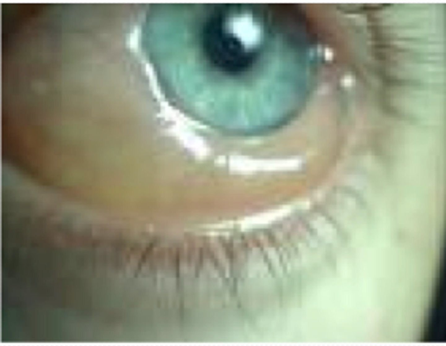 <p>•Swelling of the conjunctiva due to exudation from abnormally permeable capillaries; associated with hyperthyroidism</p><p>•Nonspecific sign of eye irritation</p><p>•The eyes may become difficult or impossible to fully close</p>