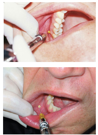 <ul><li><p>the fold formed by the oral mucosa where it passes from the mandible or maxilla to the cheek</p></li><li><p>many of the local anesthesia injections for patient pain control and hemostasis are administered at the height or depth of the mucobuccal fold</p></li></ul><p></p>