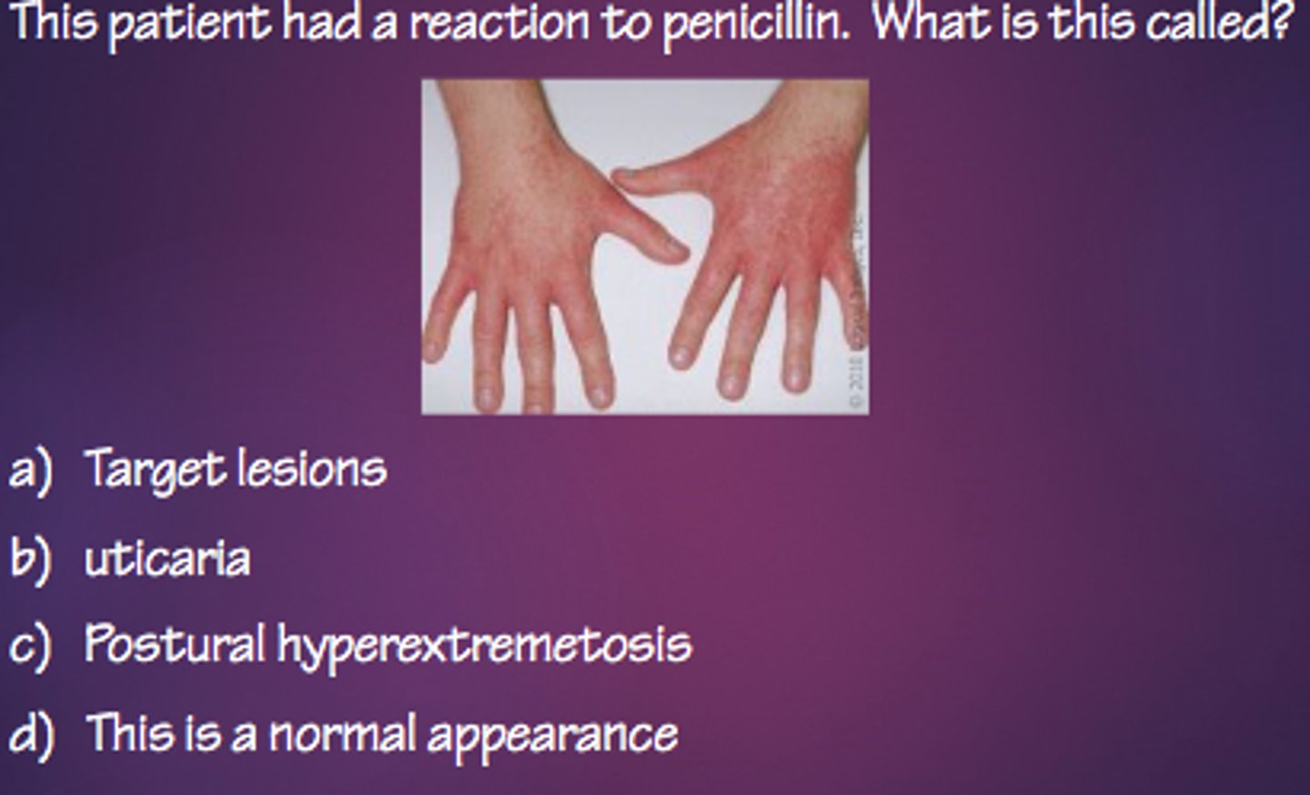 <p>the patient had a reaction to penicillin. what is this called?</p><p>a. target lesions</p><p>b. urticaria</p><p>c. postural lhyperextremetosis</p><p>d. this is a normal appearance</p>