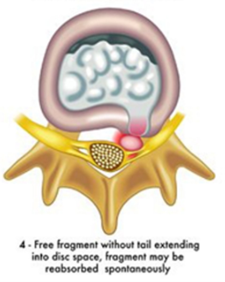<p>discal fragment broken off</p>